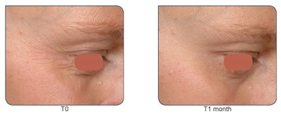 After 1 month of pressed serum