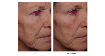 Anti-Wrinkle Sederma