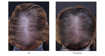 Hair Loss Sederma