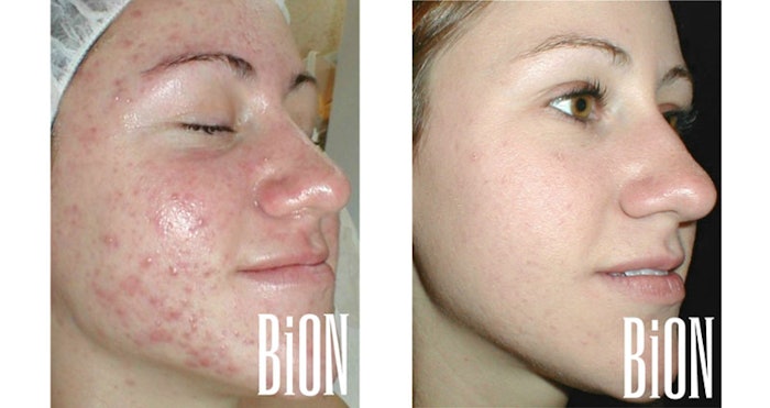 bion_si1706_lead