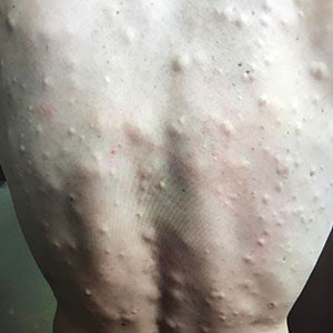 %40drpimplepopper+%2F+via+Instagram