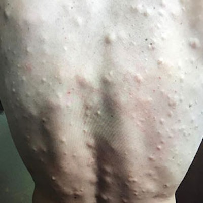 %40drpimplepopper+%2F+via+Instagram