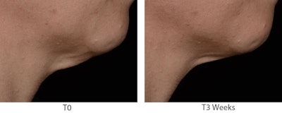 Sederma Lead 2