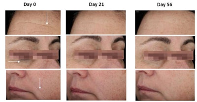 Replexium is the newest solution to help consumers regain a more youthful appearance and achieve their beauty aspiration. Regain 7 years’ younger skin in 3 weeks. *