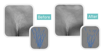 Gatuline In-Tense MB is a concentrated oily extract from the flower of the Acmella plant, also called Paracress or “Brède mafane”—a traditional spicy condiment. Gattefossé notes Acmella is renowned for its high content in alkylamides, which has proven to be an excellent marker of anti-aging efficacy. To produce the ingredient, special attention is notably given to selective and sustainable harvesting of the flowers (upper buds only) to ensure the reproduction of the specie.