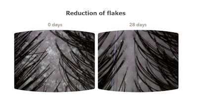 In another study, men and women with dandruff applied a 3% Seascalp™ biomarine ingredient serum on their scalps once a day for 28 days. After the application ended, benefits in helping manage inflammation-prone scalps were seen for two additional weeks, reducing inflammation reoccurrences and providing extended scalp protection and comfort.