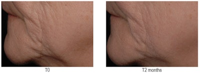 To learn more, ask for Feminage™ literature and sample by clicking here