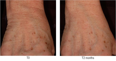 Crystalide®, our highlighter-like peptide, is the last example that will be presented here as it is based on an inhibition of mRNAs at the epidermis level. Indeed, thanks to a specific vectorization, Crystalide® benefits from a uniform spreading at the skin surface allowing an optimized targeted bioavailability in the epidermis.