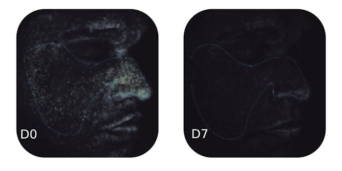 Above are results taken by Visia to show the signs porphyrins in the cheek and nose region of the volunteers. Visia provides data that quantification of porphyrins (white dots) in the delimited region (contour) of the cheek and nose of volunteers on day 0 (D0) and treated with Miracne by 7 (D7).