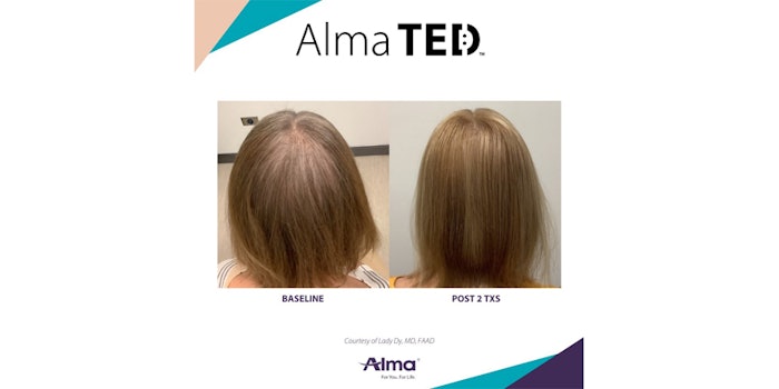 Visible results after two treatments