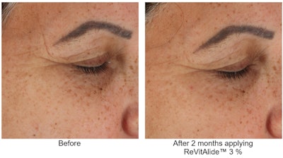 Sederma Gci2209 Before After