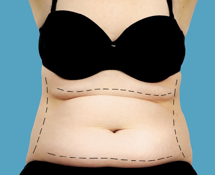 Learn about the advances in minimally invasive techniques for postpartum rejuvenation and how they make the procedure cheaper and more effective.