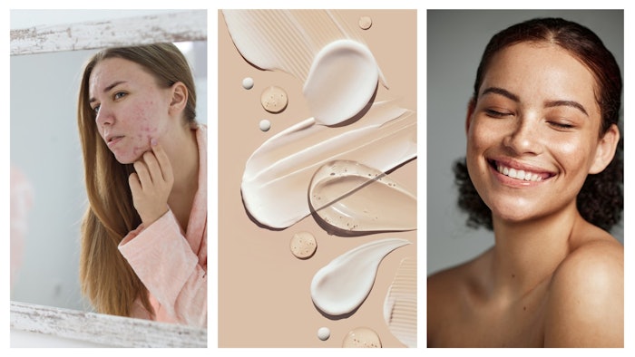 There are aesthetic and mental well-being dimensions to addressing acne; fortunately, there are effective technical solutions and marketing claims available to brand formulators and marketers.