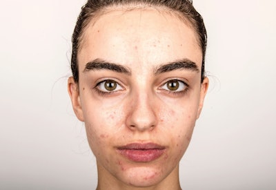 Biocogent’s DermaPhage CA is a bio-active designed to target acne-causing microbes.