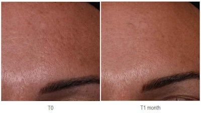 Luceane was shown in vivo to slow the skin aging process by five years after just one month of application.