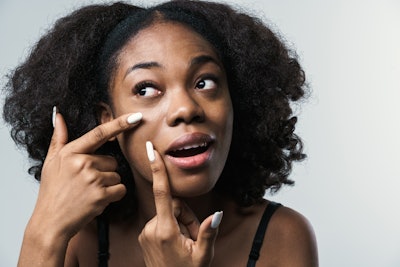 Of those respondents suffering from acne, more than 70% had received negative comments about their condition/appearance. And 40% had been suffering the condition for more than 10 years. Furthermore, nearly 74% suffered from post-inflammatory hyperpigmentation.