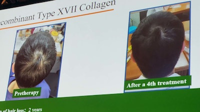 A clinical study of a serum containing the ingredient found that after microneedle applications, subjects saw reduced hair loss and improved hair density and diameter.