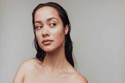 During the 2023 SCC annual meeting in New York, Sederma’s Alba Cico, Ph.D., previewed a new peptide to improve C. acnes-induced skin damage.