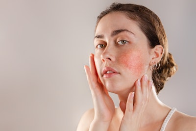 Inflammation can mean the obvious—redness of the skin—but it can also refer to neurogenic inflammation that leads to the unpleasant, hypersensitive feeling of the affected skin.