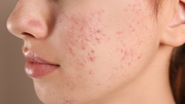 Teenage girl with acne problem on beige background, closeup