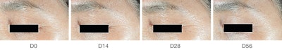 Twice daily application of 1% SYN-UP™ significantly reduced wrinkle volume on the crow’s feet.