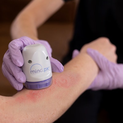 Mind.Px from Mindera Health genetic analysis test uses a dermal biomarker patch (DBP) to determine response to a biologic drug class for psoriasis patients.