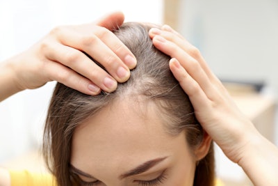 Per Spate, “hormonal hair loss” is one of the fastest-growing consumer hair searches online. Related searches include “how to stop hormonal hair loss,” “can hormonal hair loss be reversed” and “what treatments are available?”