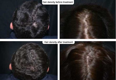 Algaktiv Densidyl clinical efficacy hair density before after images
