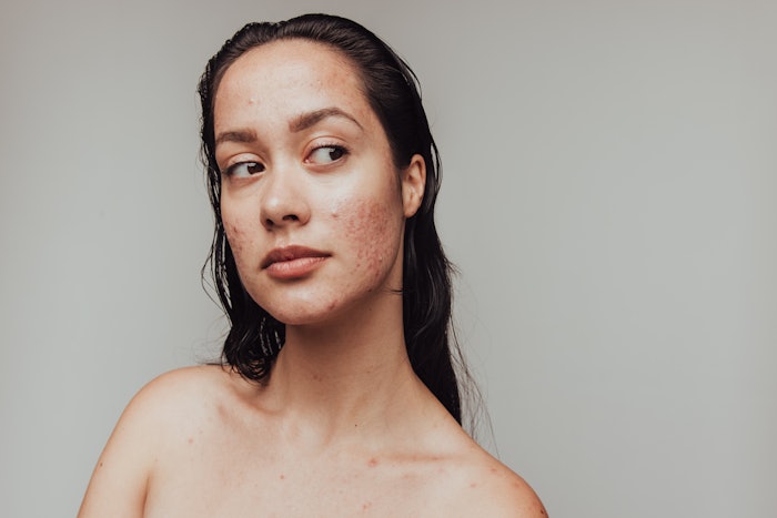 New skin care product release from Active Concepts featuring BioAuthentic Exosomes to help fight inflammation.