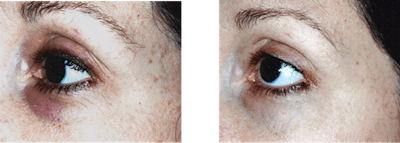 By improving microcirculation, this ingredient technology can improve the appearance of dark circles and puffiness under the eye. Pictured are digital camera images for a selected subject; from left: untreated (day 0) and 5% active formulation (week 8).