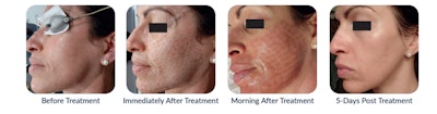 Reverse by Aerolase combines cutting-edge laser technology to rejuvenate and maintain skin health.