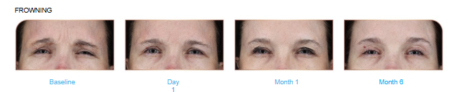 Before and after of Relfydess treating frown lines.