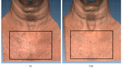 3D reconstruction of the décolleté region to analyze wrinkle reduction and texture improvement after 28 days with 0.5% Ecoffea Citrus treatment