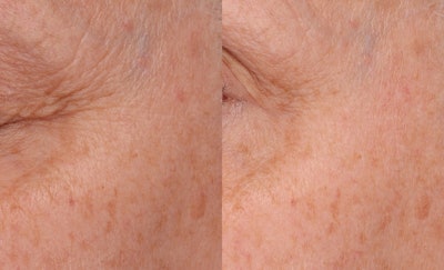 Case 1b (cropped): Expression lines are a critical component of the appearance of crow’s feet, and simply opening/closing the eyes at varying levels dramatically changes their visibility.