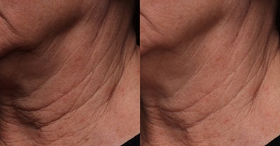 Case 4b (crop): If we were to crop in on just the neck region, it would appear that there is a huge change in the appearance of the folds and skin texture. In reality, all we’ve actually done is add a subtle lower soft light to the mix coming up from below the face.