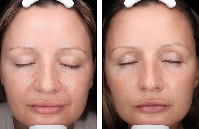 Pictured here is a clinical test subject before/after captured by Visia skin analysis. This image was created during a clinical test of RoC Skincare RoC 35 protocol users. All tests were conducted at clinics in France, with participants aged 45-plus, who reported their skin looked an average of 9.6 years younger after 90 days.