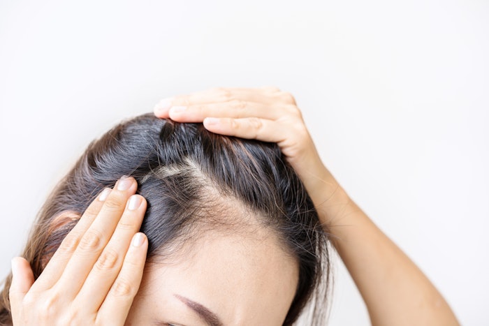 Hair loss and thinning remain pervasive concerns, impacting a significant portion of the global population and driving a robust, innovation-fueled market within the beauty industry.