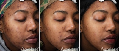 Baseline, End of Treatment Course, 90 Days Post-Treatment Course