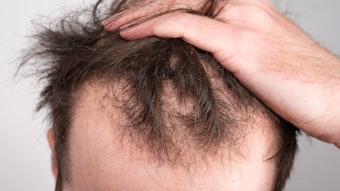 Man Hand In Hair Thinning On Top Alopecia Adobe Stock 473136928