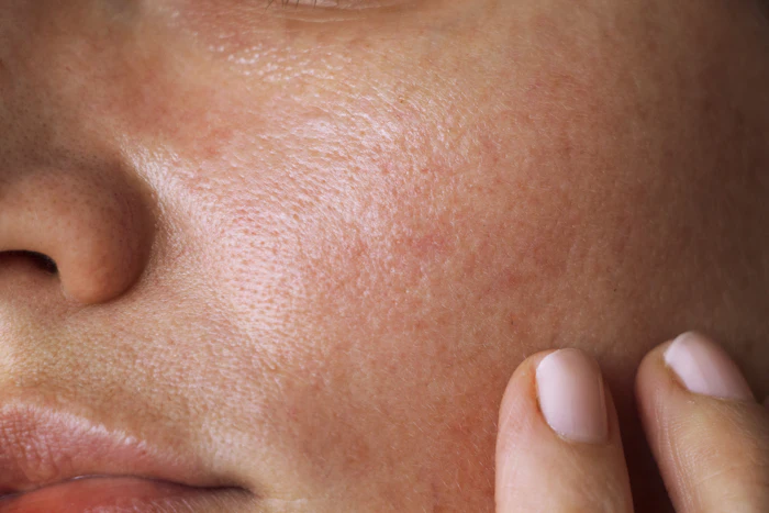 Positioned as a clinically supported alternative to traditional depigmentation agents, Tonasulike-D is designed for inclusion in premium skin care and pre- and post-procedure formulations.