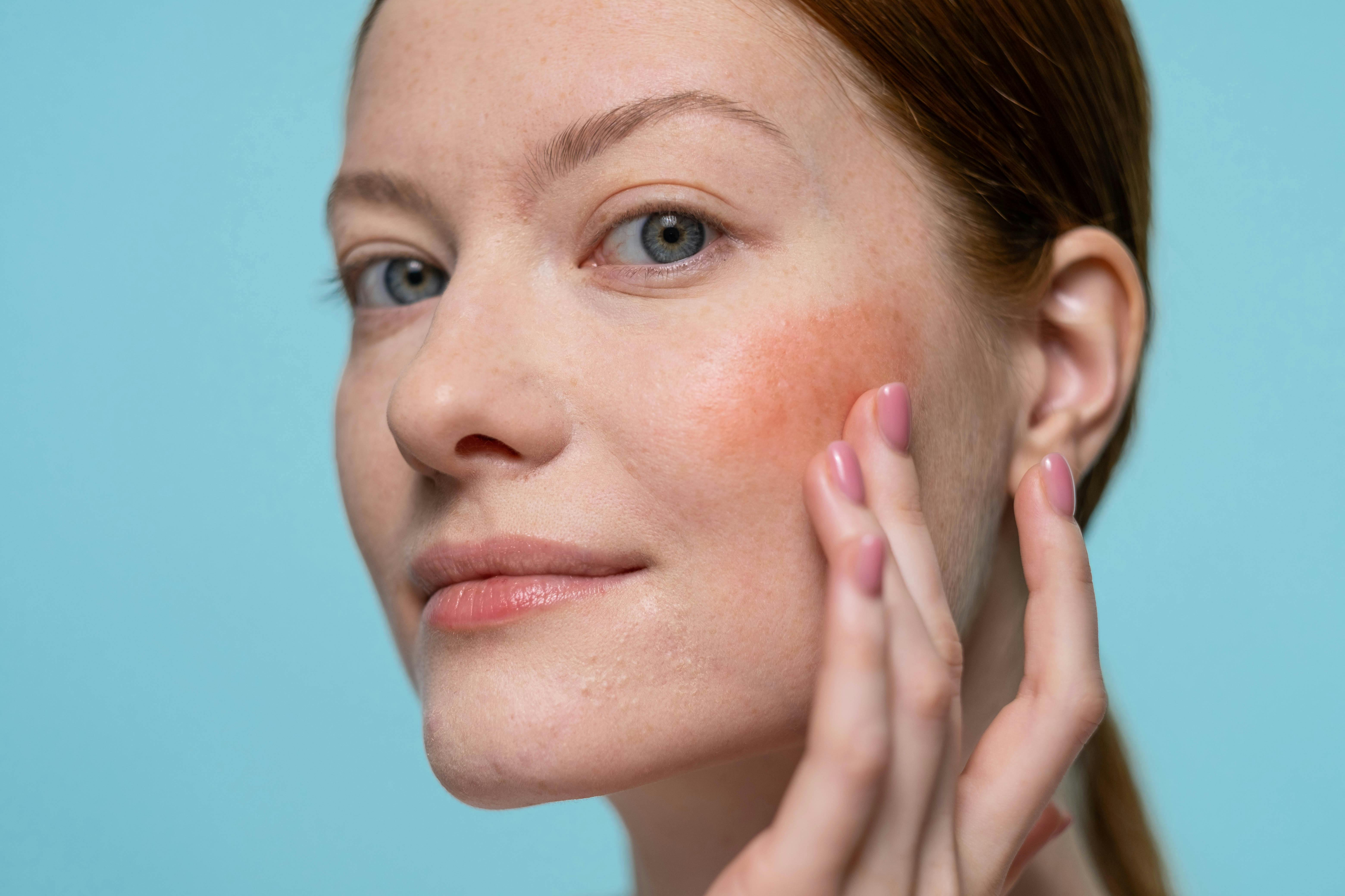Many current &ldquo;sensitive skin&rdquo; formulations are designed around anti-inflammatory mechanisms used in rosacea management, including approaches targeting Demodex and antimicrobial peptide activity.