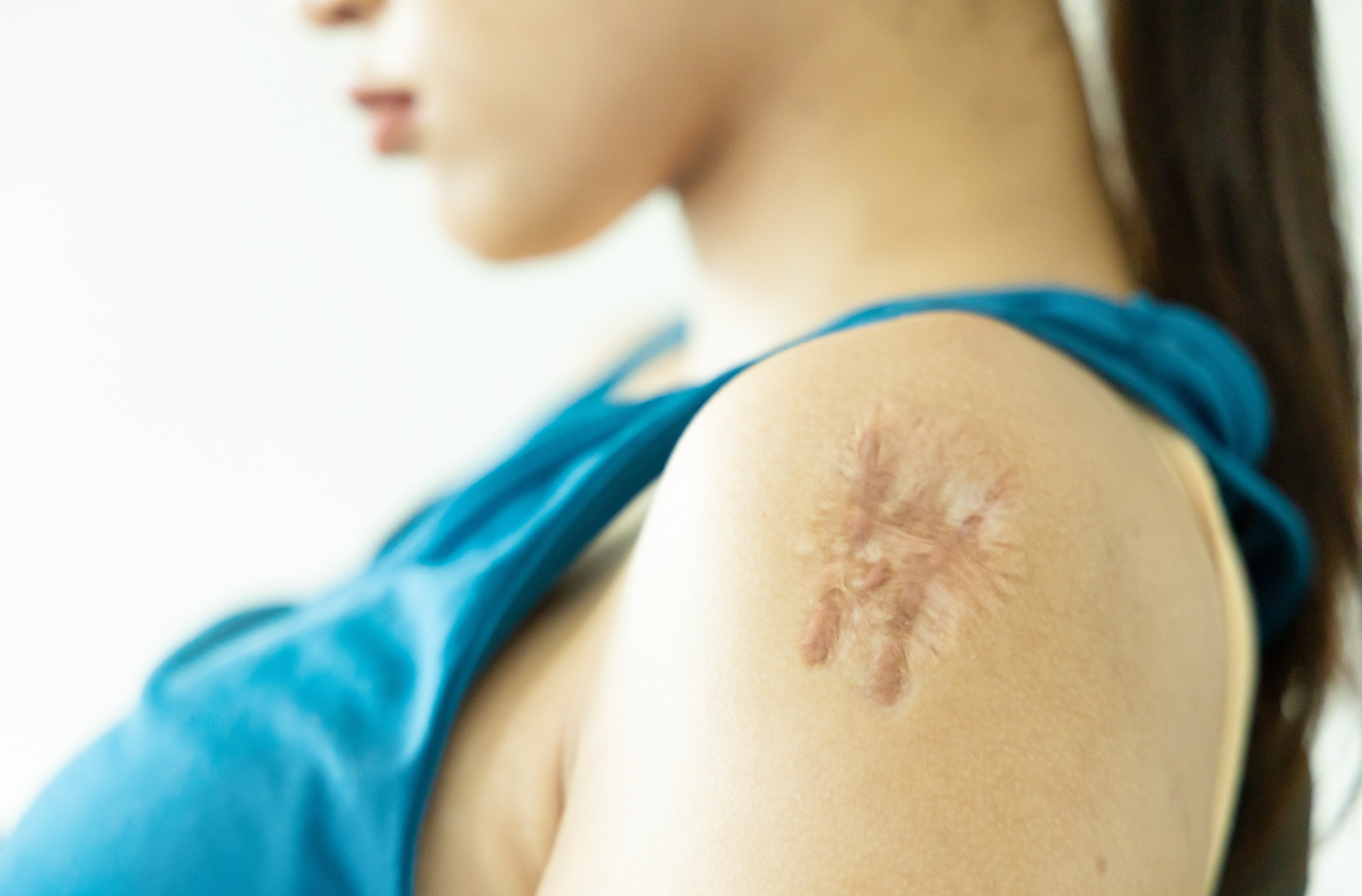 OliX is currently developing RNAi candidates for hair loss, hypertrophic scars, metabolic disorders and other conditions, leveraging its proprietary OASIS delivery platform.