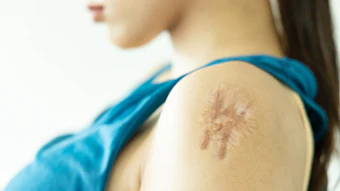 OliX is currently developing RNAi candidates for hair loss, hypertrophic scars, metabolic disorders and other conditions, leveraging its proprietary OASIS delivery platform.