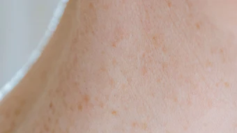 Close-up of fair skin with freckles and light spots near shoulder