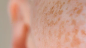 Outer Bio is positioning Yuna as a platform for identifying previously unknown mechanisms and molecules in living human skin, rather than primarily optimizing familiar cosmetic actives or delivery systems. The company says its objective is to discover new mechanisms of action and the compounds that drive them.